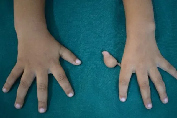 Clinical photograph, Congenital Hand Differences