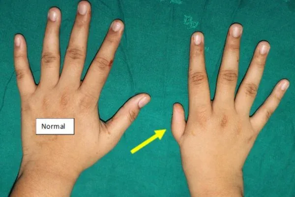 Clinical photograph, Congenital Hand Differences