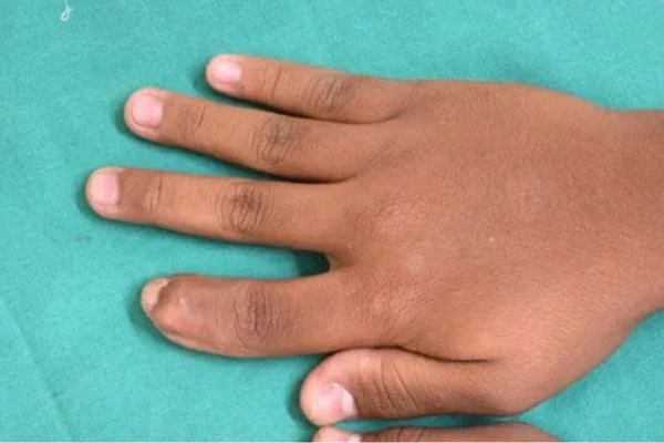 Clinical photograph, Congenital Hand Differences