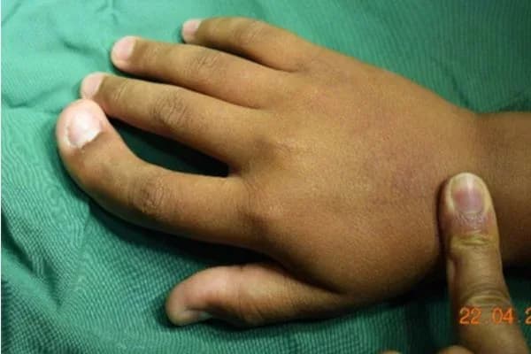 Clinical photograph, Congenital Hand Differences