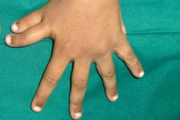 Clinical photograph, Congenital Hand Differences