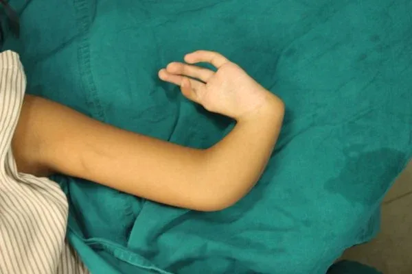 Clinical photograph, Congenital Hand Differences