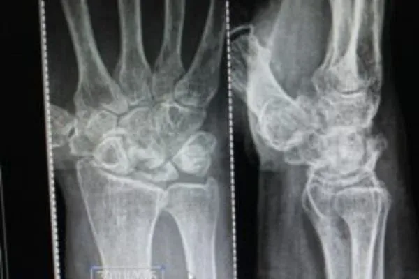 Clinical photograph, Congenital Hand Differences