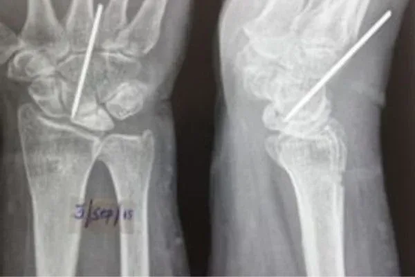 Clinical photograph, Congenital Hand Differences