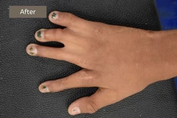 Clinical photograph, Congenital Hand Differences