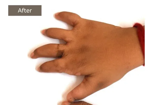 Clinical photograph, Congenital Hand Differences