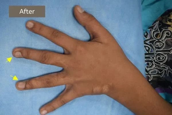 Clinical photograph, Congenital Hand Differences