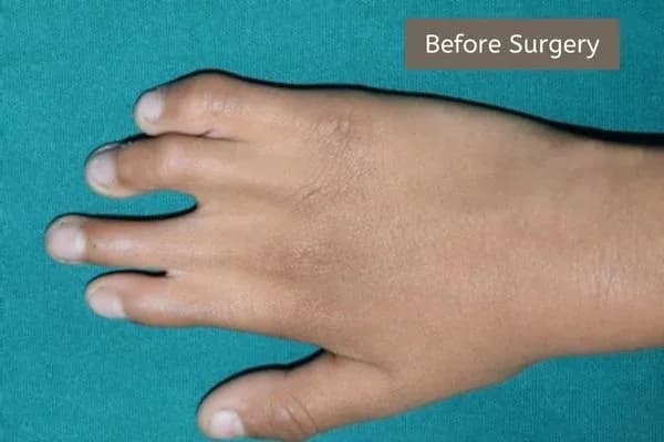 Clinical photograph, Congenital Hand Differences
