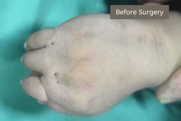 Clinical photograph, Congenital Hand Differences