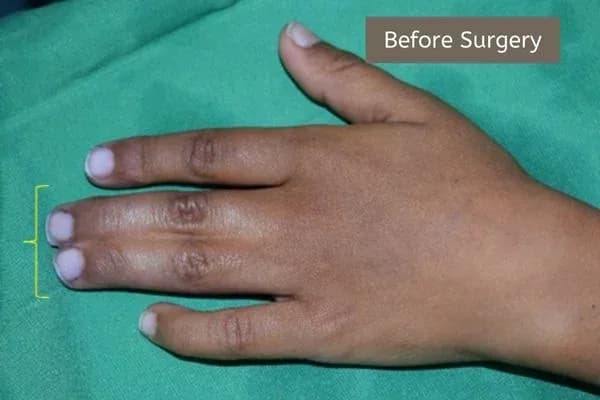 Clinical photograph, Congenital Hand Differences