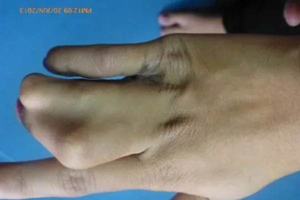 Clinical photograph, Congenital Hand Differences