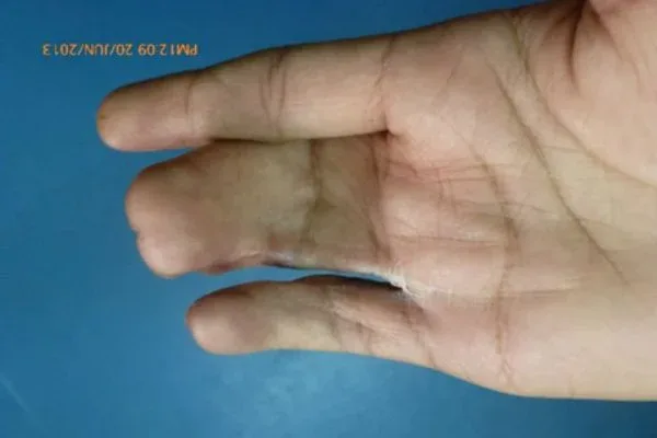 Clinical photograph, Congenital Hand Differences