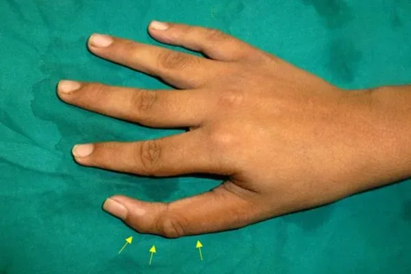 Clinical photograph, Congenital Hand Differences