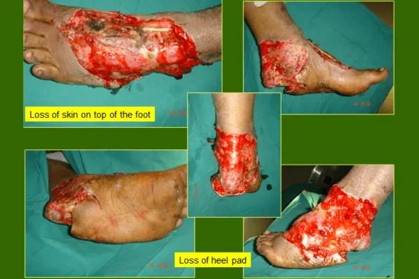 Clinical photograph, Flaps & Skin Cover