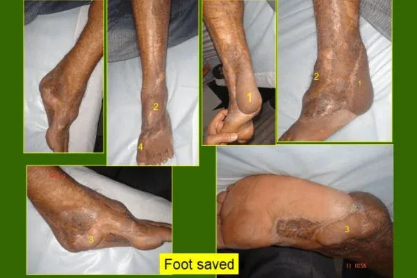 Clinical photograph, Flaps & Skin Cover