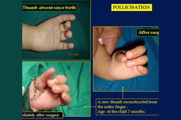 Clinical photograph, Blue Finger & Circulation